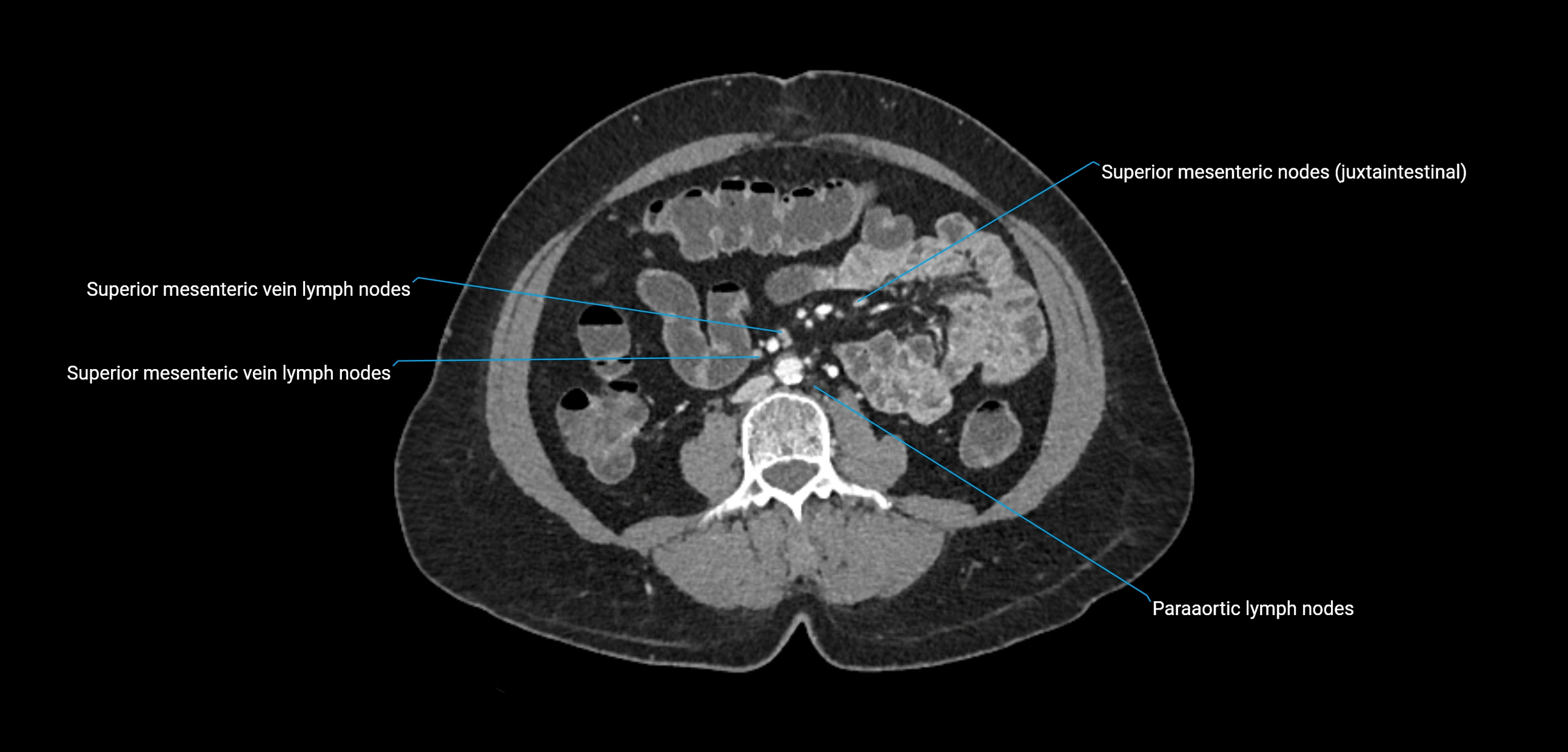CT ct abdominal lymph nodes  axial cross sectional anatomy  enchanced radiology image -img-00002-00240.webp